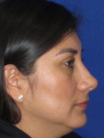 Rhinoplasty Before & After Gallery - Patient 344483 - Image 6