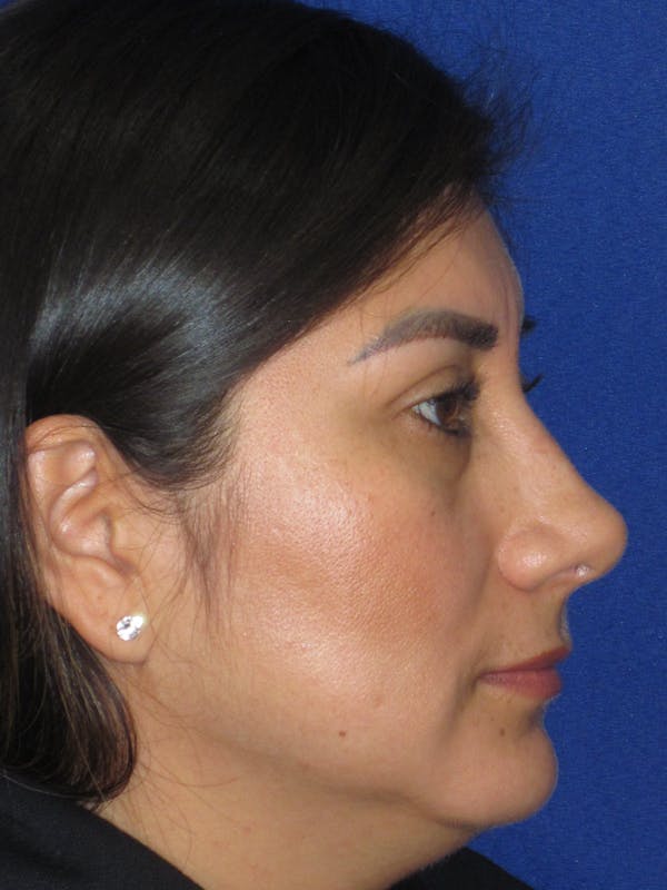 Rhinoplasty Before & After Gallery - Patient 344483 - Image 6