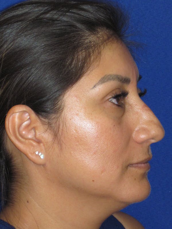 Rhinoplasty Before & After Gallery - Patient 344483 - Image 5