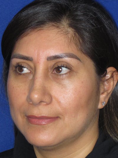Rhinoplasty Before & After Gallery - Patient 344483 - Image 8
