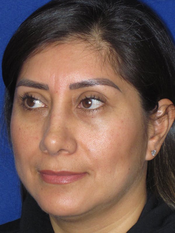 Rhinoplasty Before & After Gallery - Patient 344483 - Image 8