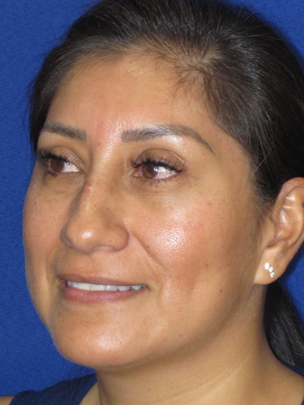 Rhinoplasty Before & After Gallery - Patient 344483 - Image 7