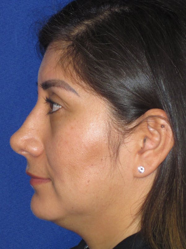 Rhinoplasty Before & After Gallery - Patient 344483 - Image 10