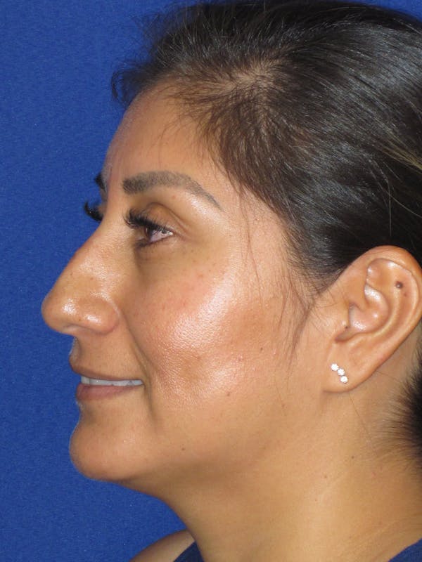 Rhinoplasty Before & After Gallery - Patient 344483 - Image 9
