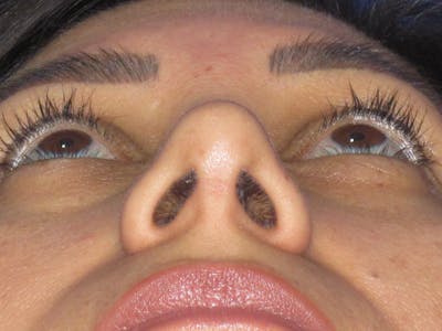 Rhinoplasty Before & After Gallery - Patient 344483 - Image 12