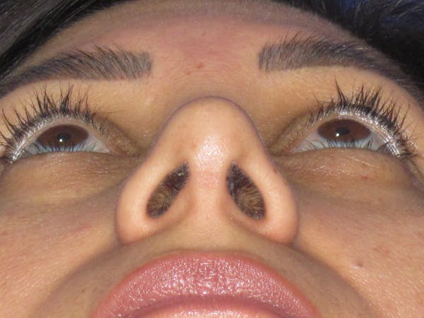 Rhinoplasty Before & After Gallery - Patient 344483 - Image 12