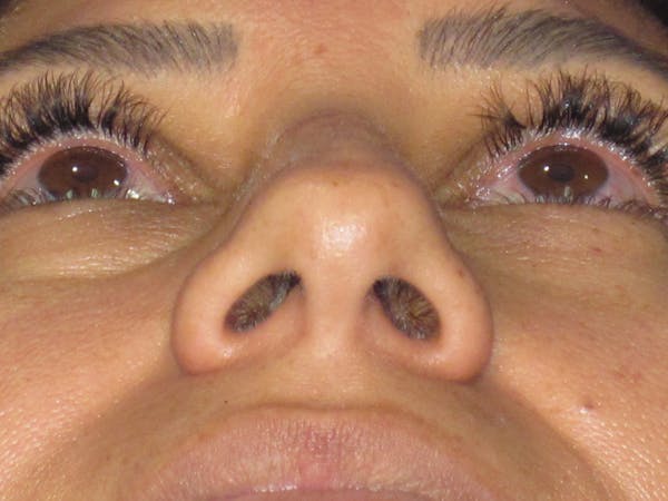 Rhinoplasty Before & After Gallery - Patient 344483 - Image 11