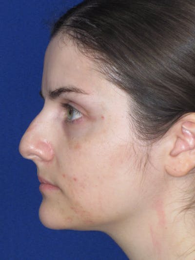 Rhinoplasty Before & After Gallery - Patient 338318 - Image 1
