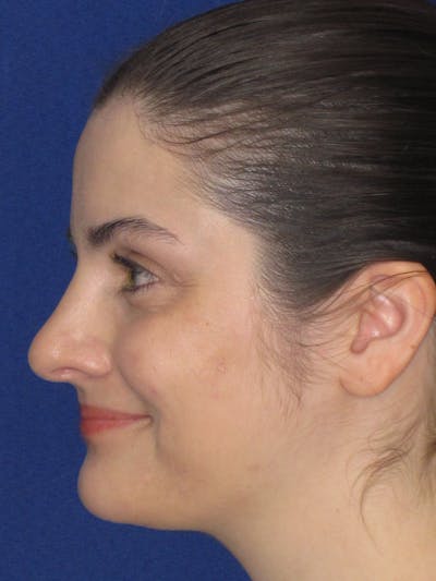 Rhinoplasty Before & After Gallery - Patient 338318 - Image 4