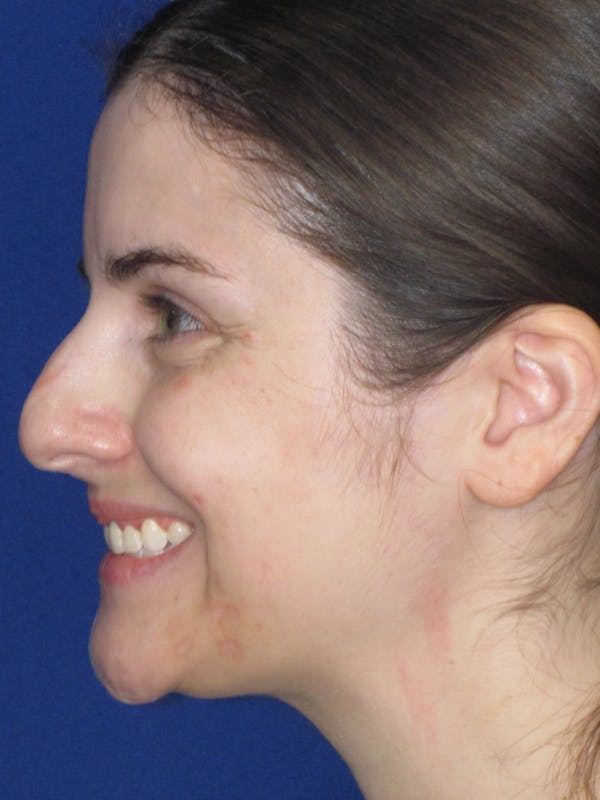 Rhinoplasty Before & After Gallery - Patient 338318 - Image 3