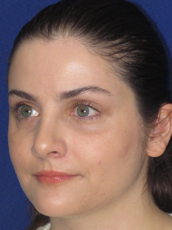 Rhinoplasty Before & After Gallery - Patient 338318 - Image 6