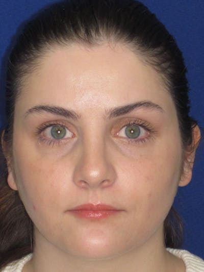 Rhinoplasty Before & After Gallery - Patient 338318 - Image 8