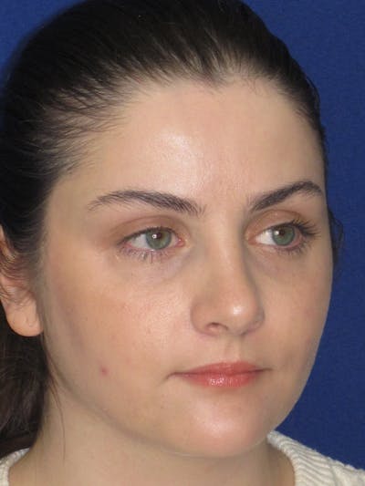 Rhinoplasty Before & After Gallery - Patient 338318 - Image 10