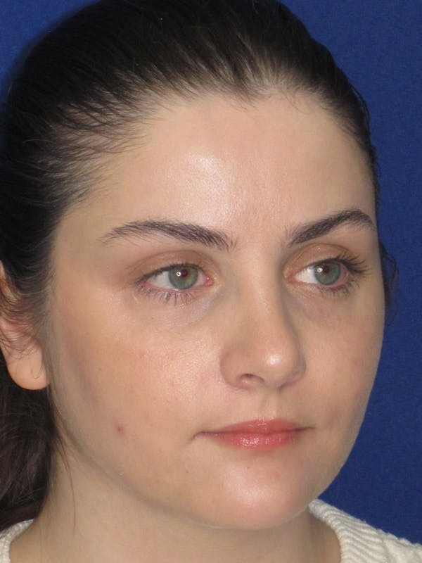 Rhinoplasty Before & After Gallery - Patient 338318 - Image 10