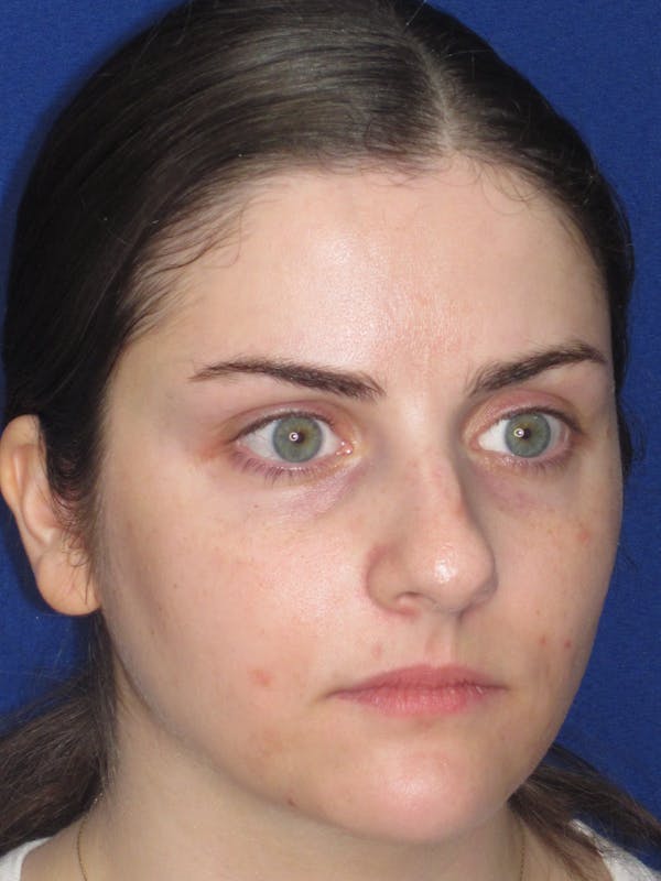 Rhinoplasty Before & After Gallery - Patient 338318 - Image 9