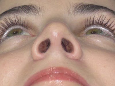 Rhinoplasty Before & After Gallery - Patient 338318 - Image 12