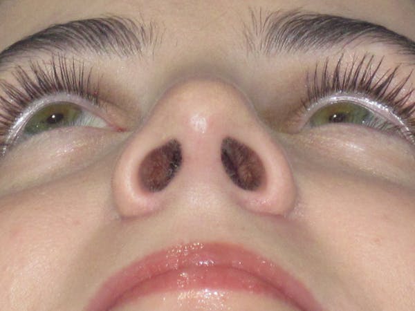 Rhinoplasty Before & After Gallery - Patient 338318 - Image 12