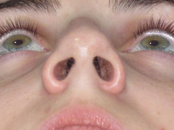 Rhinoplasty Before & After Gallery - Patient 338318 - Image 11