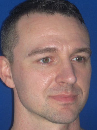 Rhinoplasty Before & After Gallery - Patient 293614 - Image 4