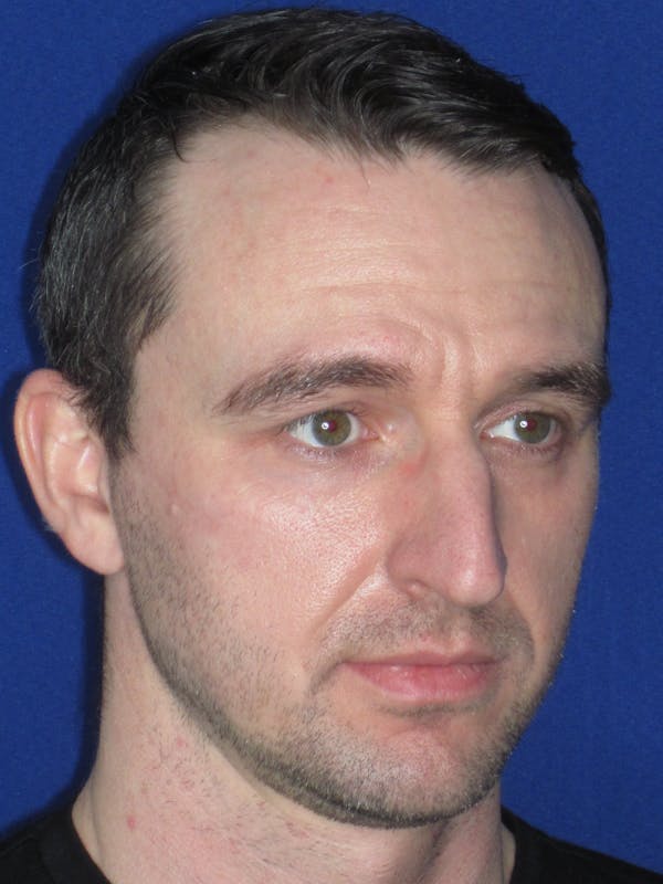 Rhinoplasty Before & After Gallery - Patient 293614 - Image 3