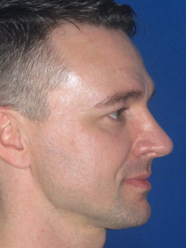 Rhinoplasty Before & After Gallery - Patient 293614 - Image 6