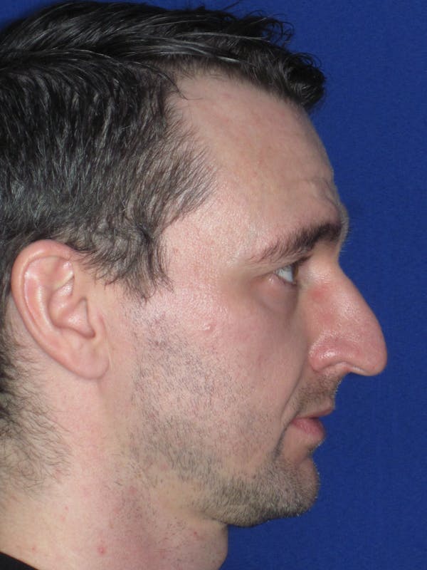Rhinoplasty Before & After Gallery - Patient 293614 - Image 5