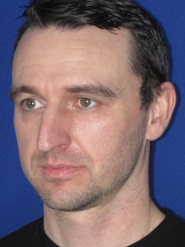 Rhinoplasty Before & After Gallery - Patient 293614 - Image 7