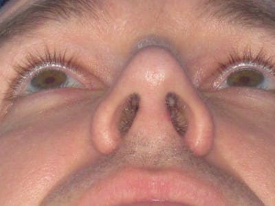 Rhinoplasty Before & After Gallery - Patient 293614 - Image 10