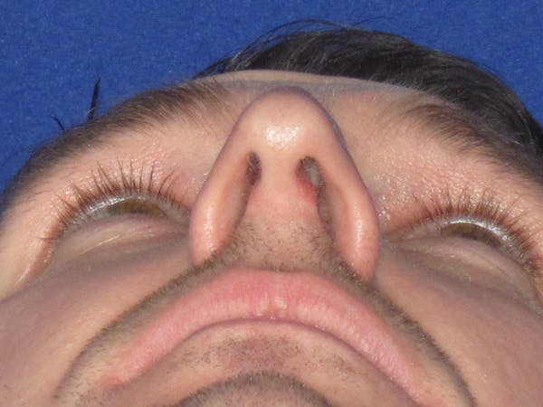 Rhinoplasty Before & After Gallery - Patient 293614 - Image 9