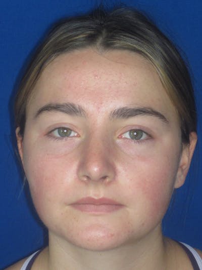 Rhinoplasty Before & After Gallery - Patient 276363 - Image 2
