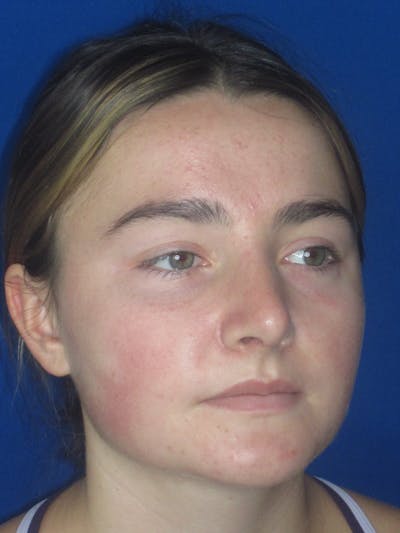Rhinoplasty Before & After Gallery - Patient 276363 - Image 4