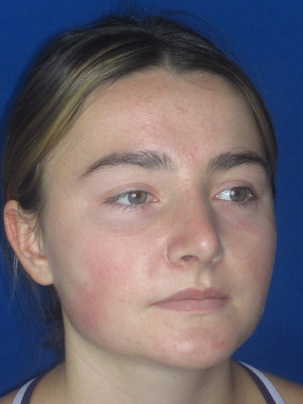Rhinoplasty Before & After Gallery - Patient 276363 - Image 4