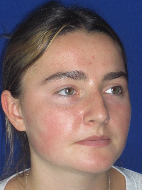 Rhinoplasty Before & After Gallery - Patient 276363 - Image 3