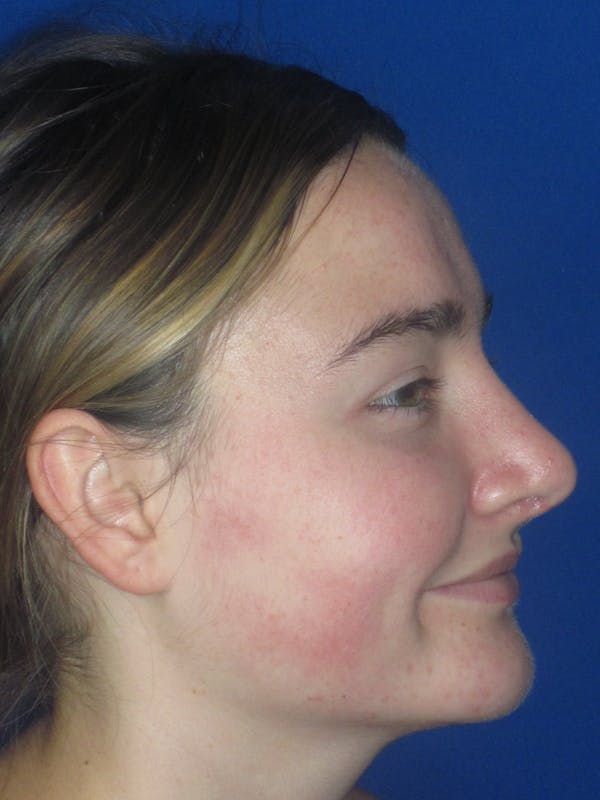 Rhinoplasty Before & After Gallery - Patient 276363 - Image 6