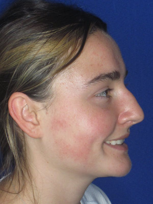 Rhinoplasty Before & After Gallery - Patient 276363 - Image 5