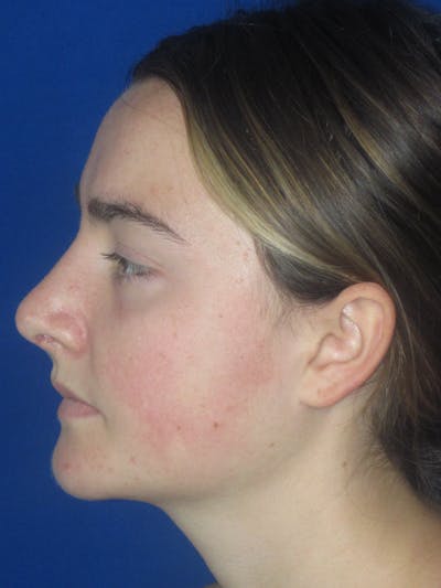 Rhinoplasty Before & After Gallery - Patient 276363 - Image 8