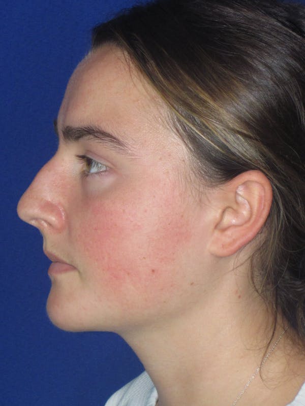 Rhinoplasty Before & After Gallery - Patient 276363 - Image 7