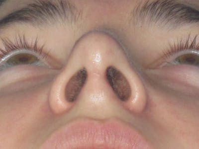 Rhinoplasty Before & After Gallery - Patient 276363 - Image 10