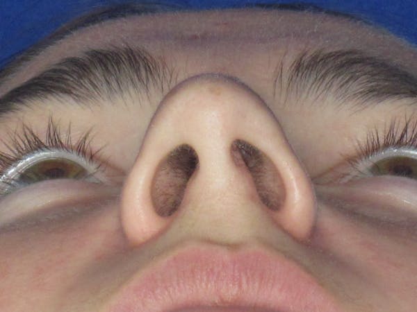 Rhinoplasty Before & After Gallery - Patient 276363 - Image 9