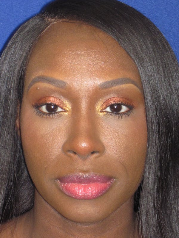 Rhinoplasty Before & After Gallery - Patient 413779 - Image 2