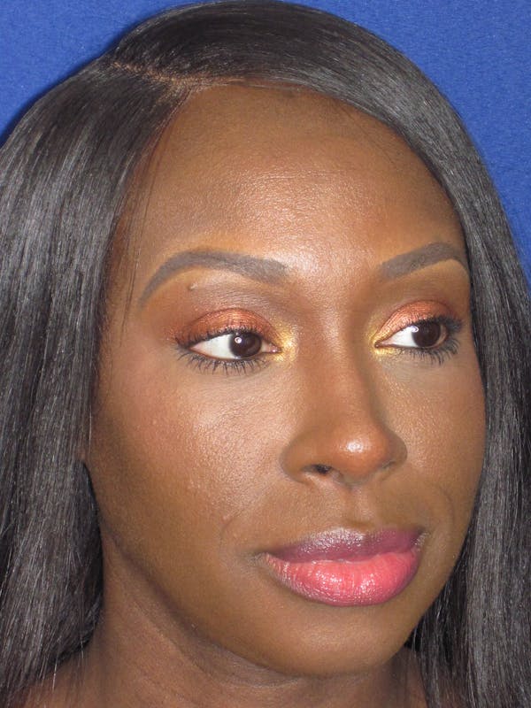 Rhinoplasty Before & After Gallery - Patient 413779 - Image 4