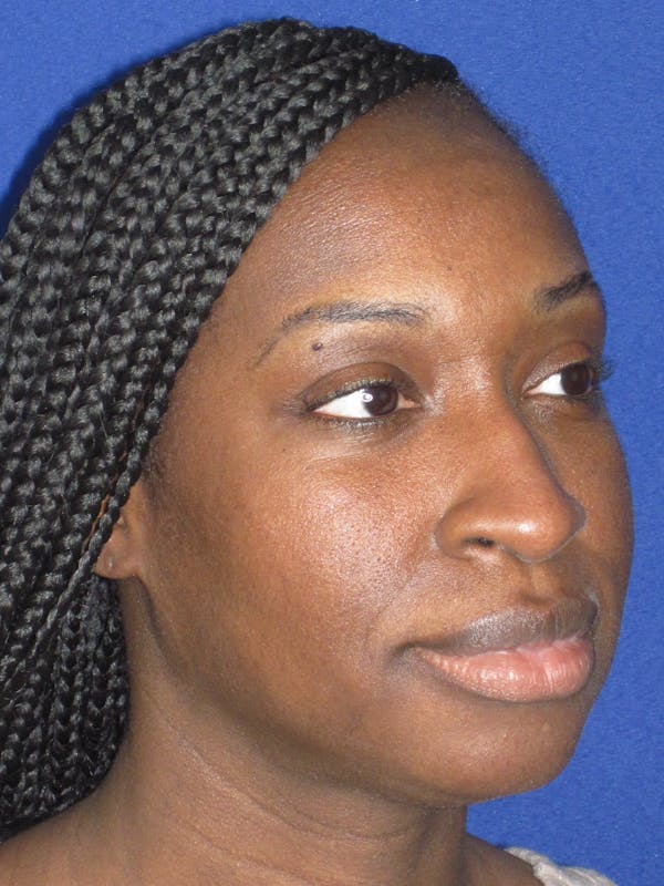 Rhinoplasty Before & After Gallery - Patient 413779 - Image 3