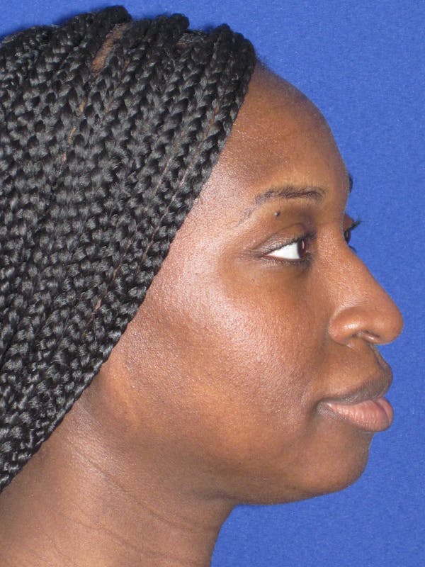 Rhinoplasty Before & After Gallery - Patient 413779 - Image 5
