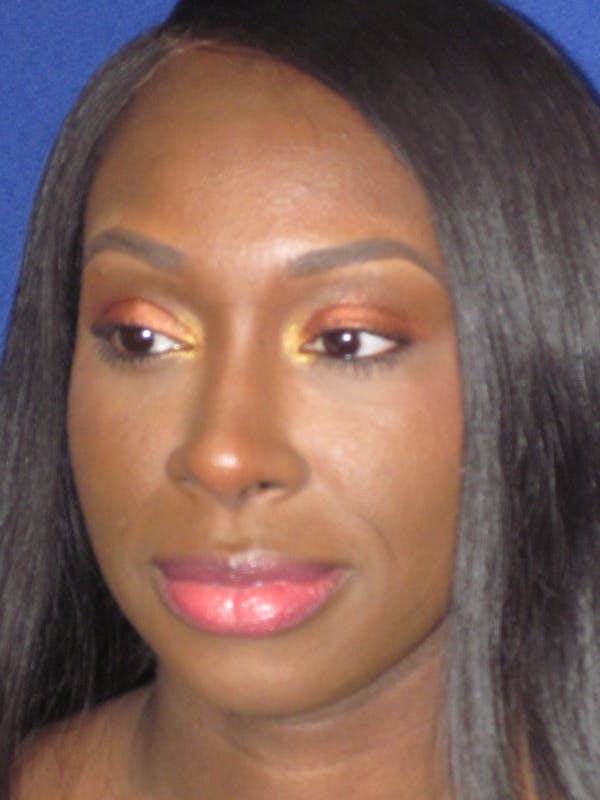 Rhinoplasty Before & After Gallery - Patient 413779 - Image 8