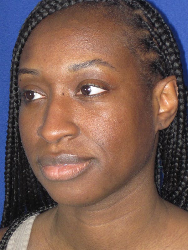 Rhinoplasty Before & After Gallery - Patient 413779 - Image 7