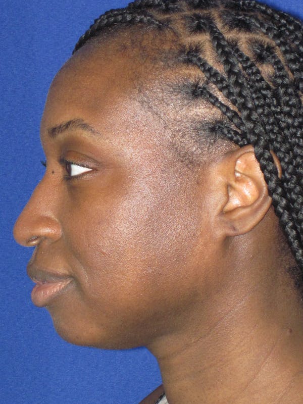Rhinoplasty Before & After Gallery - Patient 413779 - Image 9