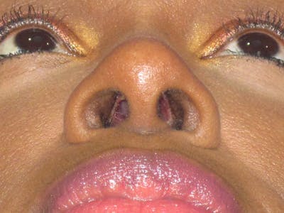 Rhinoplasty Before & After Gallery - Patient 413779 - Image 12