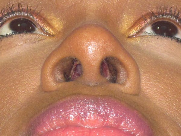 Rhinoplasty Before & After Gallery - Patient 413779 - Image 12