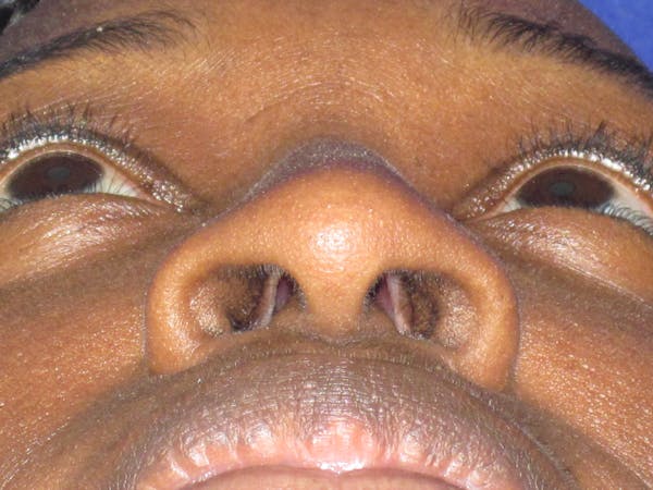 Rhinoplasty Before & After Gallery - Patient 413779 - Image 11