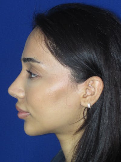 Rhinoplasty Before & After Gallery - Patient 533445 - Image 2